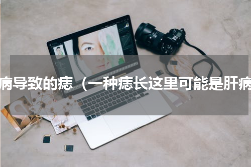 肝病导致的痣（一种痣长这里可能是肝病）