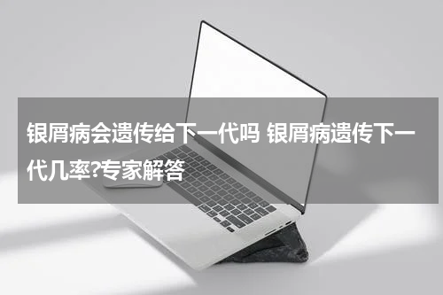 银屑病会遗传给下一代吗 银屑病遗传下一代几率?专家解答